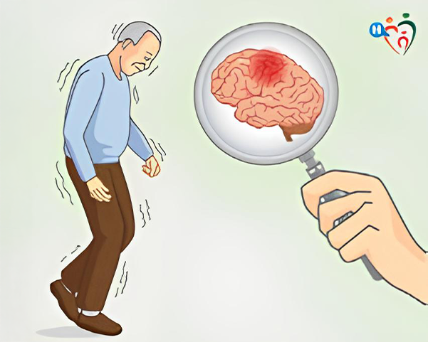 Il  Parkinsonismo